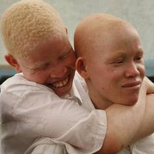 Afrique : Pas facile d’être albinos !